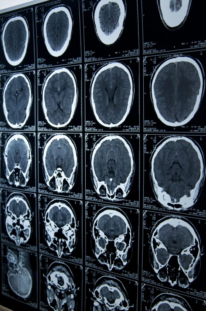 Brain Injury Lawyer San Jose, CA
