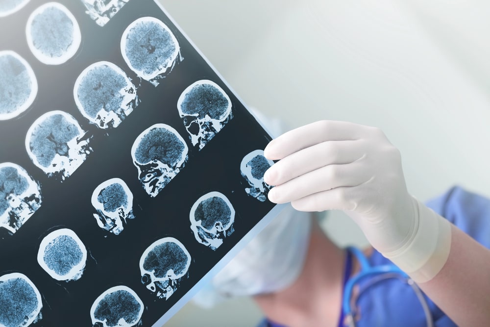 brain injury lawyer San Jose, CA