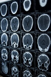 Brain Injury Lawyer In San Jose
