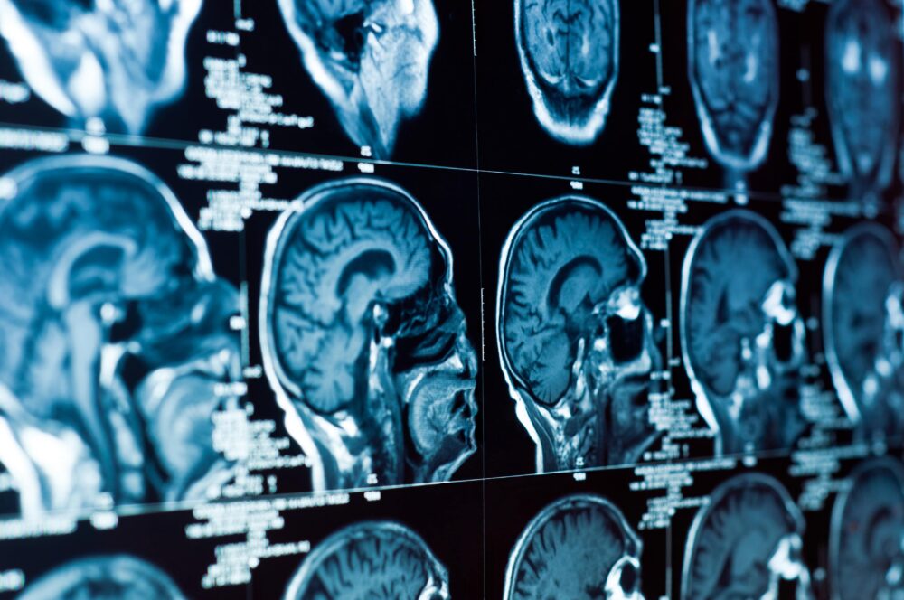 brain injury lawyer Monterey, CA